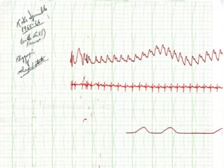 Polygraph Chart - 1