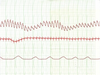 Polygraph Chart - 2