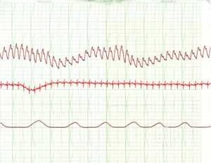 Polygraph Chart - 2