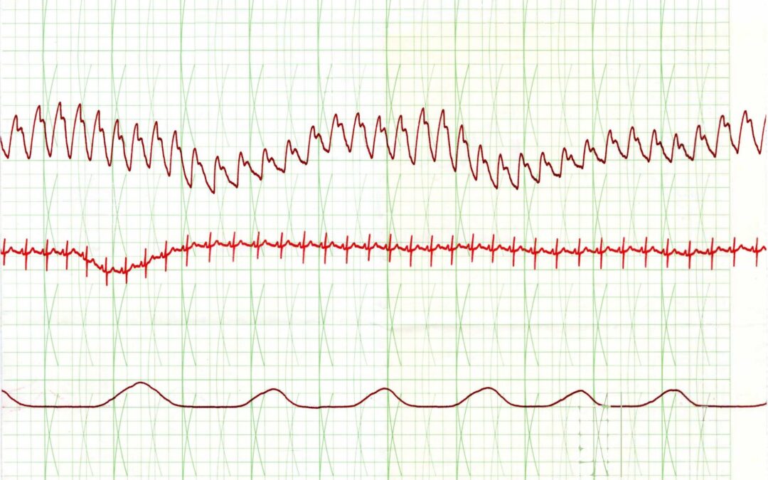 Polygraph Chart – 2